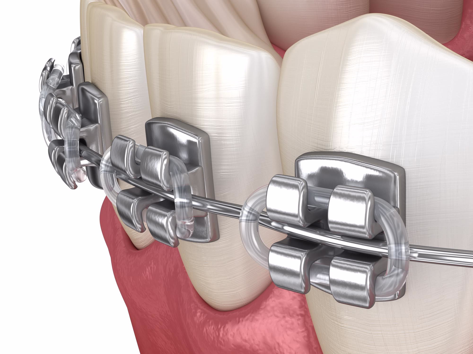 Close-up 3D illustration of metal orthodontic brackets and a wire secured with clear elastic ligatures on teeth.